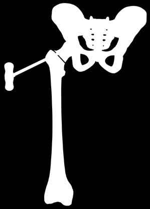 Çimentolu Asetabular Kap (Acetabular Cup) ve Çimentosuz Press Fit