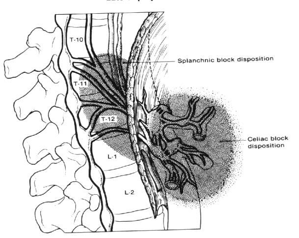 Splanknik blok Floroskopi, CT eşliğinde perkütan, cerrahi