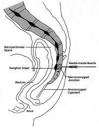 Spinal iğne bükülerek, veya intradiskal ulaşılır, İğnenin anteriorda,