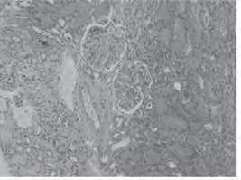 Karaciğer segment de 4x0x0 mm boyutlarında periferik kalsifikasyon içeren lobule konturlu hipodens kistik lezyon Giriş: FSGS, glomerüler hasarın bir histolojik paternidir ve primer ya da sekonder