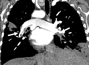 5. OLGU ÖRNEKLERİ Olgu 1. A. Koronal curved MIP reformat görüntüde pulmoner arter sağ ve sol dallarında (oklar) emboli. B.
