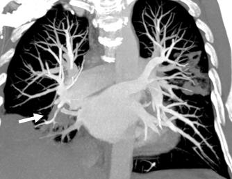 Popliteal venlerde (oklar) hipodens dolum defektleri E. Doppler incelemede sağ femoral vende (ok) akım izlenmemekte F.