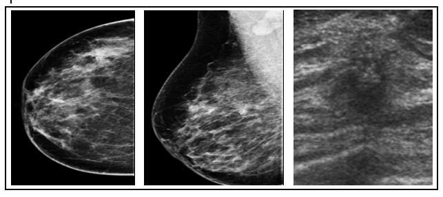 düzeyinde, yaklasik 10x10 mm boyutlarda, mamografi ve US