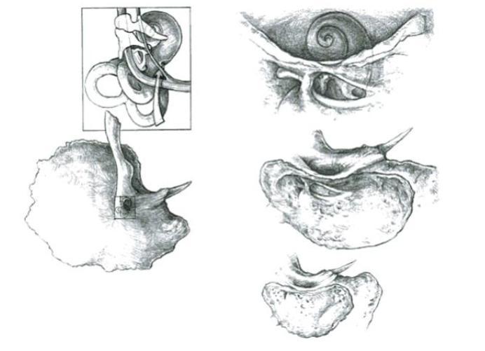 34 Resim 9:Kortikal mastoidektomi,fasyal reses yaklaşımı (Edwards LC.