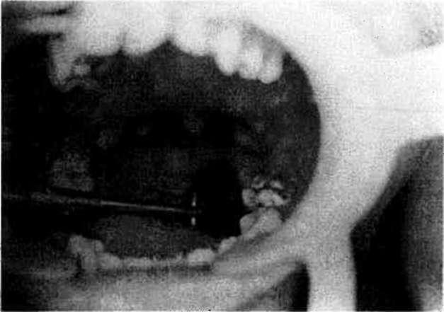 Hertzberg ve ark. (15)'mn yaptıkları çalışmada incelenen hastaların %50'sinde dişlerarası diastemalar olduğu bildirilmiştir.