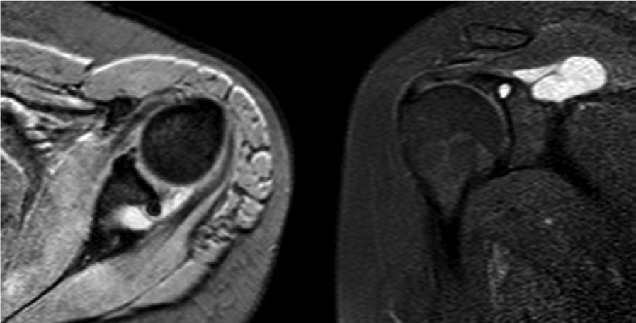 Anadolu Klin / Anatol Clin tam olduğu görüldü. Ameliyattan bir yıl sonraki kontrolde yakınmaları tamamen sona ermişti ve MR görüntülemede kistik yapı izlenmedi (Görsel 3b).