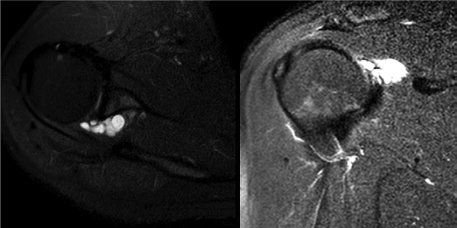 Olgu 1 a) Ameliyat öncesi gangliyon kistinin T2 sekansında MR görüntüsü; b) ameliyat sonrası MR görüntüsü b a de glenohumeral eklemin posteriyorunda, supraskapular sinir komşuluğunda lobule kistik