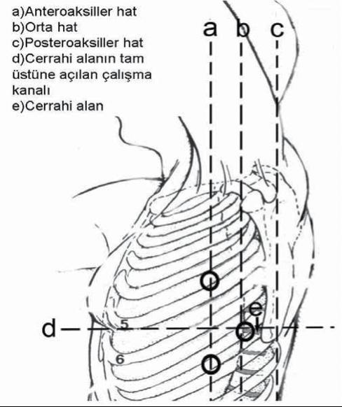 sonra parietal plevra diseke edilerek kesilir, cerrahi saha distraktör ile genişletilir. Mikroskop ya da endoskop ile cerrahi saha görüntülenebilir.