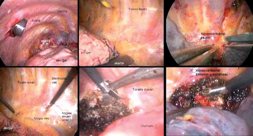 Şekil 4: Torakoskopik cerrahide intraoperatif görüntü. Şekil 5: Anterior yaklaşım sırasında, duktus torasikus yaralanmasına bağlı oluşan şilotoraksın drenaj görüntüsü.