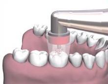 El aletinin ucuna tedavi edilecek dişe uygun boyutta, dişi sıkıca kavrayan tek kullanımlık silikon başlık takılarak, yüksek konsantrasyondaki ozon gazı doğrudan dişe uygulanmaktadır.