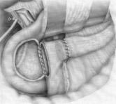 Nihat Yavuz yonunda; portal venin üzerinde pankreas transseksiyonunu takiben subtotal pankreas bafl n n rezeksiyonu söz konusudur.