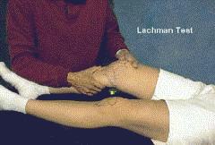 Şekil-4: Lachman testi Öne çekmece testi: Hasta supin pozisyonda yatarken kalça 45º fleksiyona, diz 90º fleksiyona alınarak bakılır. Ayak nötral pozisyonda olmalıdır.