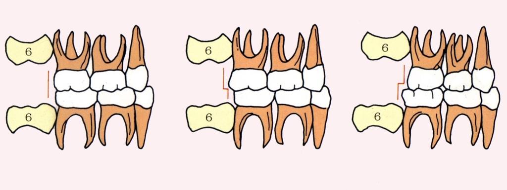 7 Vertikal tip oklüzyon (Flush terminal düzlem veya postlaktal düzlem): Alt ve üst süt 2. molarların distal yüzeyleri ön-arka yönde aynı düzlemdedir.