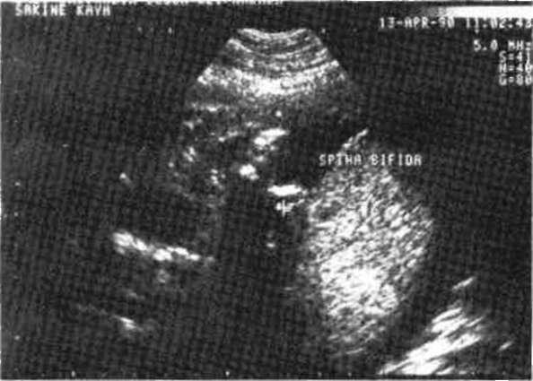 Rutin obstetrik ultrasonografinin konjenital malformasyonların prénatal tanısında tarama testi olarak klinik etkinliği ise yukarıda belirtilen klinik yararlılıklarına göre daha tartışmalıdır.