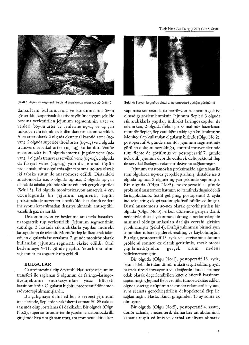 TürkPlast Cer Derg (1997) Cilt:5, Sayı:l Şekil 3: Jejunıjm segmentinin distal anastomoz sırasında görünümü dam arların bulunm asına ve korunm asına özen gösterildi.