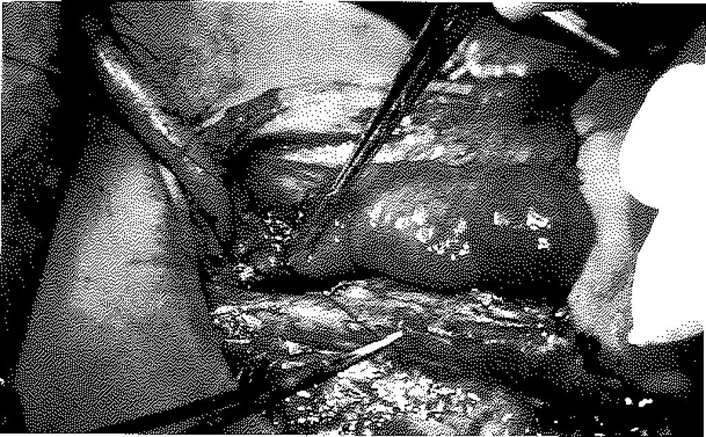 Alıcı arter olarak 2 olguda ekstemal karotid arter (uçyan), 2 olguda superior tiroid arter (uç-uç) ve 1 olguda transvers servikal arter (uç-uç) kullanıldı.