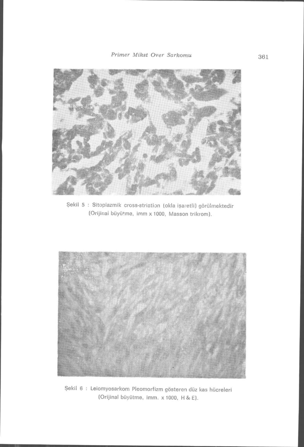 Primer Mikst Över Sarkomu 177 Şekil 5 : Sitoplazmik cross-striation (okla işaretli) görülmektedir (Orijinal büyü+me, imm x 1000, Masson