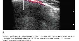 Ultrasonografi Yapan bağımlı bir teknik Normal AC kayma hareketinin pnömotoraks tanısında sensitivitesi ~%100 fakat spesifik değil Pnömotoraks Büyüklüğü Tedavi yaklaşımı büyük