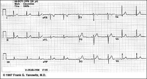 Willem Einthoven tarafından 1895 de EKG dalgalarına isimler verildi P,Q,R,S,T Charles