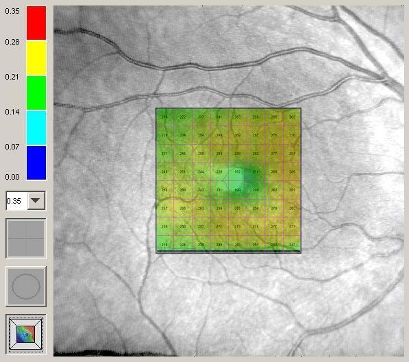 SLO Üzerinde Retinal Kalınlık SLO