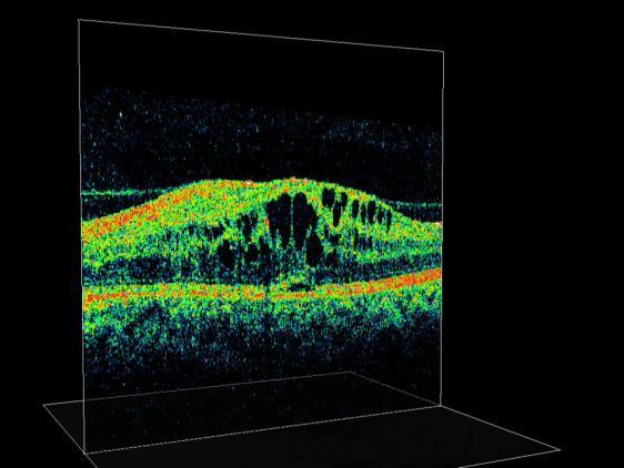 DMÖ - OCT 1. Difüz retinal kalınlaşma ( % 88 ): Tek başına görülür Sünger gibi kalınlaşma, dış tabakalarda daha belirgin 2.