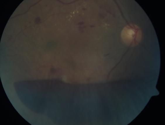 Diabetes Mellitus / Diabetik Retinopati Gelişmiş ülkelerdeki en yaygın endokrin