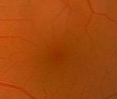 Topografik Anatomi Fovea : Makülanın merkezinde, iç retinal yüzeydeki çukurluk Fovea (1.5mm) Foveola (0.