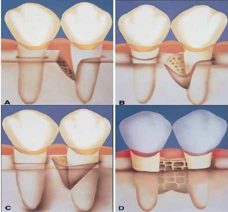 defektlerin 1/3 ünü (%35,2) ve mandibuladaki defektlerin 2/3 ünü (% 62) interdental kraterlerin oluşturduğunu bildirmişlerdir.