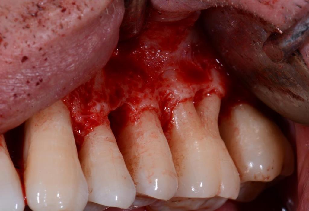 düzenlendikten sonra ölçümler anterior dişler koronal düzlemde, posterior dişler için de sagital