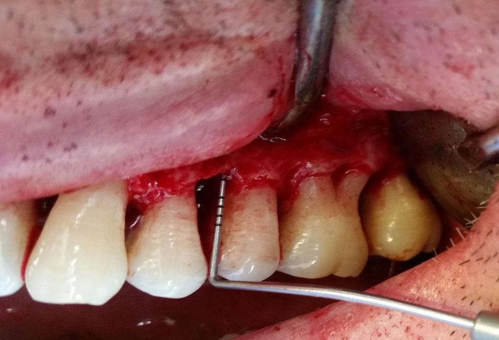 Ölçüm de dişlerin MSB ile periodontal defektin en apikal noktası belirlenerek iki nokta arasında