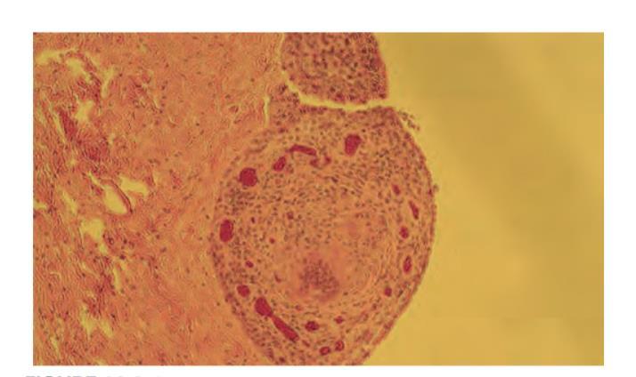 Etyopatogenez Karakteristik bulgu Non-kazeifiye epiteloid granülom Santral Monosit/Makrofaj, epiteloid