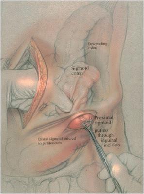 Ostomi bir organın vücut dışına ağızlaştırılmasıdır.