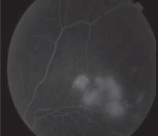 Ret-Vit 2010;18:Özel Sayı:101-107 Demircan 103 Tablo 1: Retina ven dal tıkanıklığında uygulanan