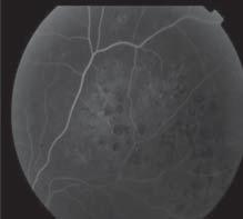 Resim 3: Scatter lazer fotokoagülasyon uygulanan iskemik retina ven tıkanıklığı olan olgunun tedavi