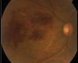 104 Retina Ven Tıkanıklığı Tedavisi Resim 5: İntravitreal bevacizumab uygulanan retina ven dal tıkanıklığı ve makula ödemi olan olgunun tedavi öncesi (a) ve sonrası (b) renkli fundus
