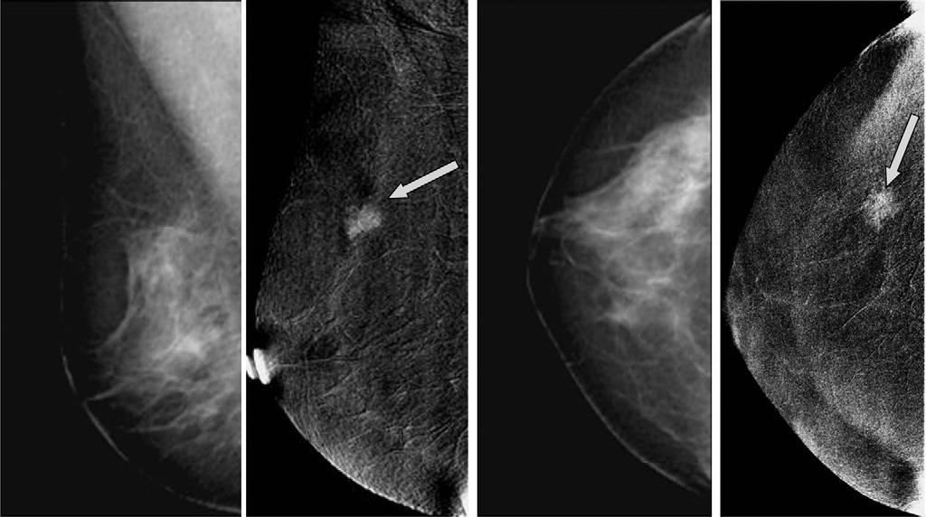 Mamografi Kontrast uygulamalı DMG Malign neovaskülarizasyon tesbiti esasına dayanır.