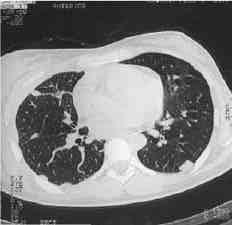 Okur E. ve ark. Resim 1. Bilateral metastazektomi yap lan bir olgunun ameliyat öncesi HRCT incelemesi. GEREÇ VE YÖNTEM Resim 2.