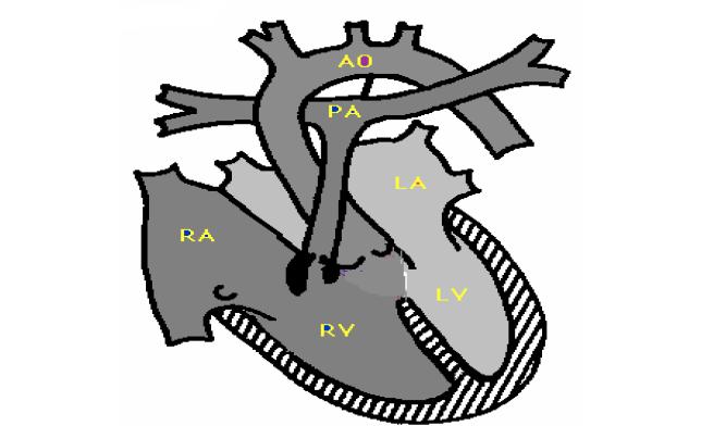 Ventriküler septal defektten olan şantın yönü ve miktarı sağ ventrikül çıkış yolundaki darlığın derecesine bağlıdır.