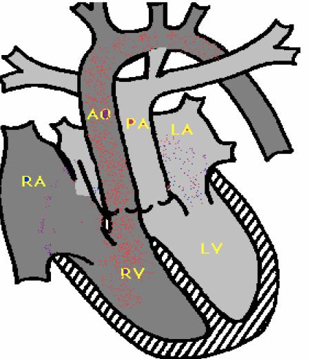 bağlıdır (22). Düzeltilmiş transpozisyonda atriyoventriküler ilişki bozulmuştur. Sağ atriyum anatomik sol ventriküle, sol atriyum anatomik sağ ventriküle bağlanmıştır.
