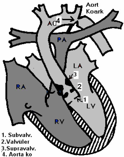 Şekil 9: Aort darlığı tipleri ve aort koarktasyonu b ) Sağ Ventikül Çıkış Yolu Darlıklarının Fizyolojisi Pulmoner darlıkta görülen fizyolojik değişiklikler, pulmoner kan akımındaki obstrüksiyonun
