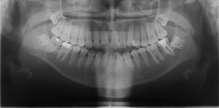 GİRİŞ Diş-çene-yüz sistemine ilişkin bölgelerin büyüme ve gelişimleri arasında normalde bir denge mevcuttur.