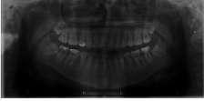 1 Bu anomalilerden birisi olan ön açık kapanış teşhisi, tedavisi ve tedavi ile elde edilen sonuçların korunması yönünden ortodontistler açısından en zor problemlerdendir.