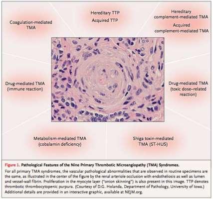 TMA Histopatoloji endotel hasarı damar duvarında değişim