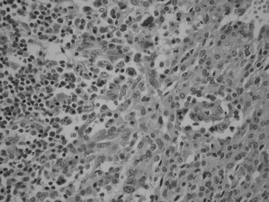 Nadir görülen histogenezi tart flmal yumuflak doku tümörleri dedir. Tümörün periferinde halka fleklinde kemik lamelleri izlenmektedir (17) (Resim 4a,b).