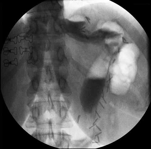 Stenosis was found to be the most common reason of reoperation in LSG group. The other complications were hiatal hernia, weight regain and leakage 7.