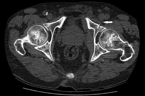 124 Figure 2. Axial CT image of the anterior column fracture (white arrow), one of the most common fracture types, when our cases were evaluated according to the Judet-Letournel classification.