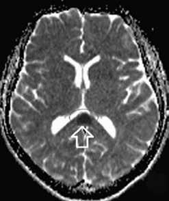 134 (a) (b) (c) (d) (e) (f) (g) (h) Figure 1. a h. Magnetic resonance imaging of case 1: Initially (a d); 10 days later (e h).