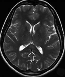 patients may present with encephalopathy with signs of mild impairment of consciousness 2,3.