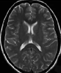 Diffusion weighed MRI showed a focal hyper-intense lesion of 12x10 mm within SCC with well-demarcated margins.