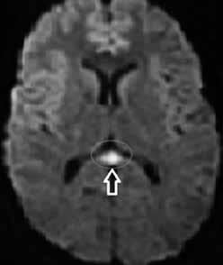 135 (a) (b) (c) (d) (e) (f) (g) (h) Figure 2. a h. Magnetic resonance imaging of case 2: Initially (a d); 10 days later (e h).